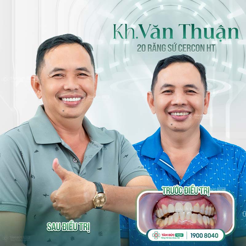 Bọc răng sứ tại Nha khoa Tâm Đức Smile khắc phục kẽ răng hàm bị đen