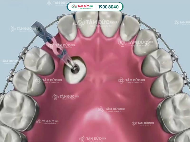 niềng răng nanh mọc ngầm