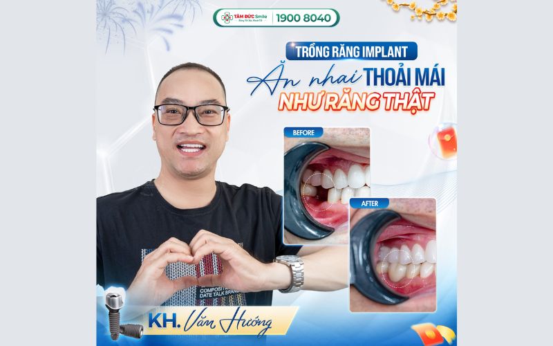 trong-rang-implant-2