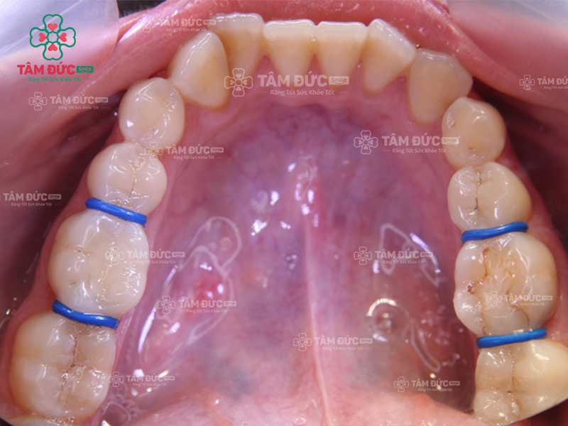 khí cụ niềng răng chun tách kẽ