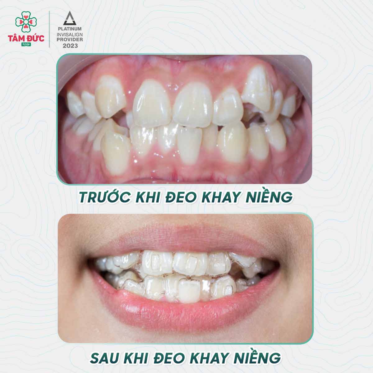 khí cụ niềng răng khay niềng trong suốt