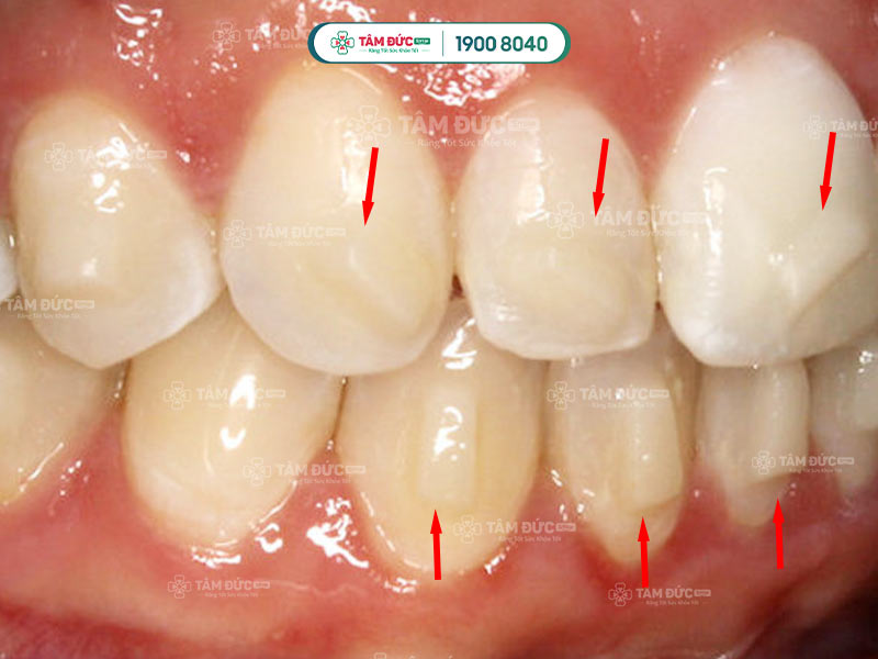 khí cụ niềng răng attachment