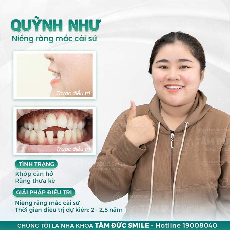 khớp cắn hở là gì