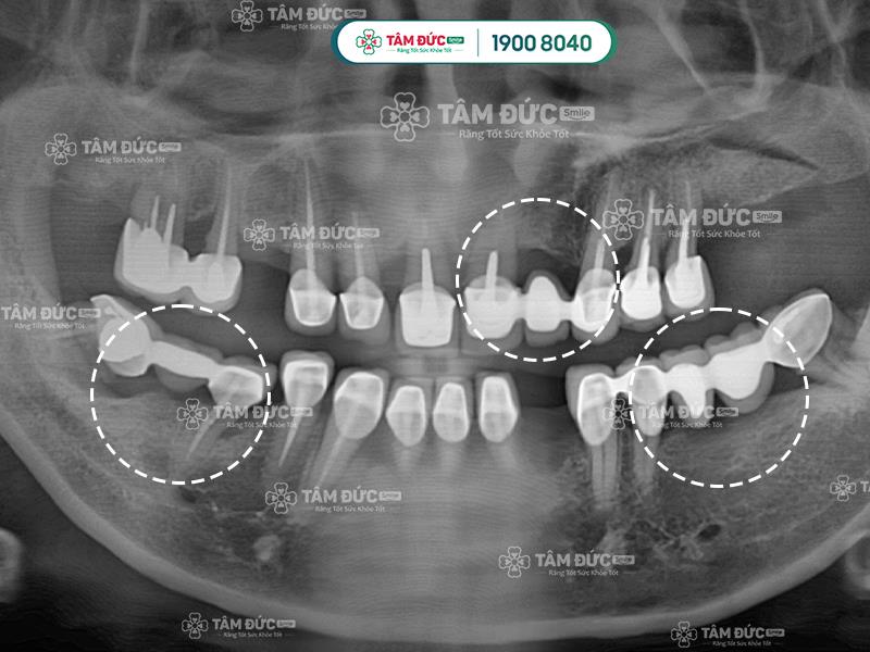 làm cầu răng sứ có tốt không