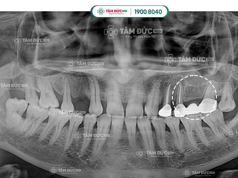 làm cầu răng sứ có tốt không