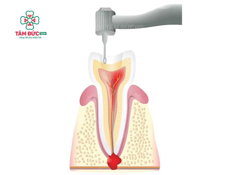 điều trị tuỷ giúp loại bỏ nguyên nhân gây áp xe răng