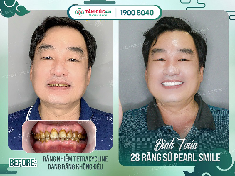 bọc răng sứ ở nha khoa Tâm Đức Smile