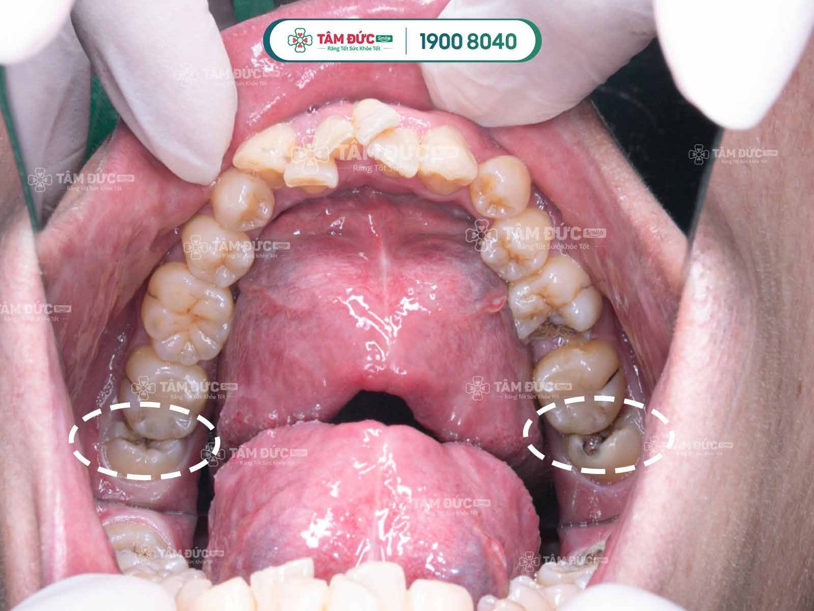 Làm sao để bớt cảm giác khó chịu khi mọc răng khôn