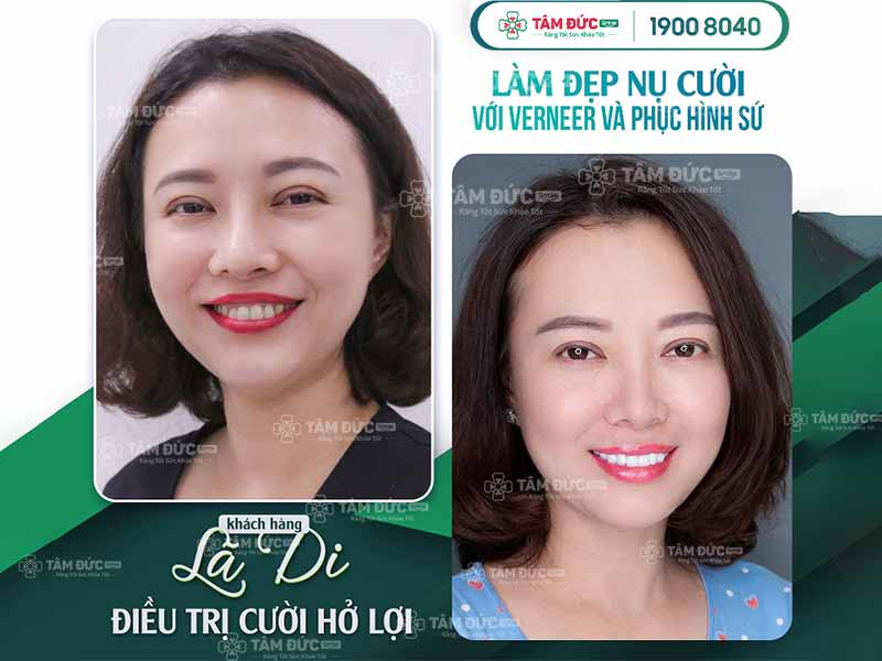 cắt nạo chóp răng là gì