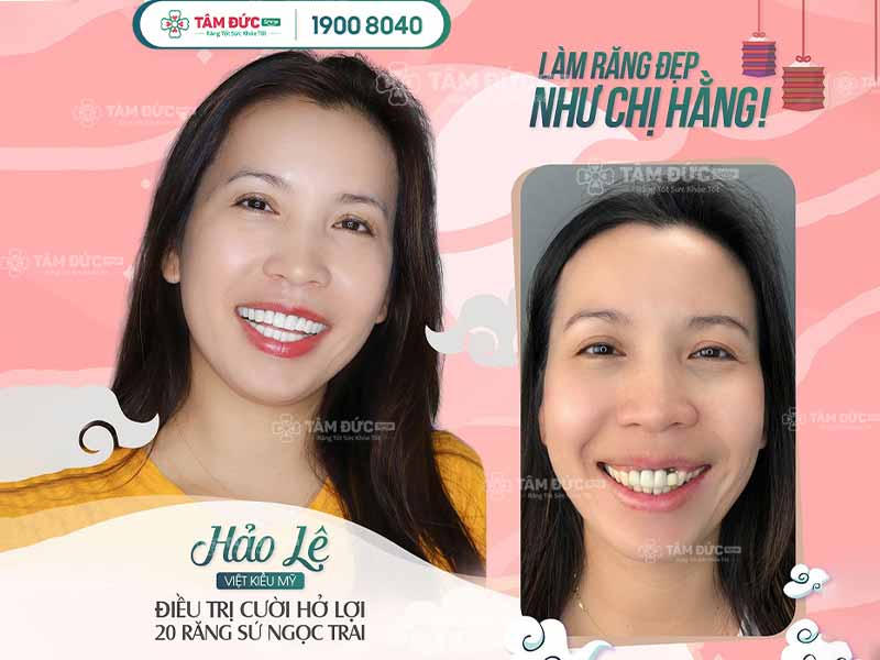 Chị Hảo cắt nạo chóp tại nha khoa Tâm Đức Smile