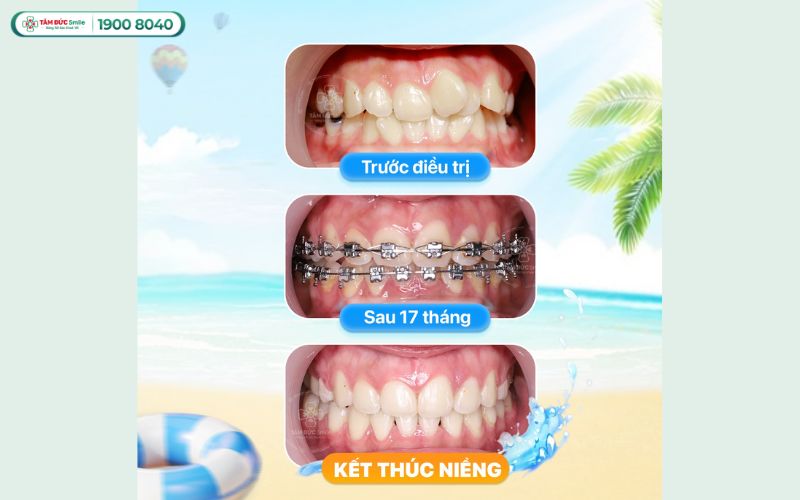 loi-ich-nieng-rang-2