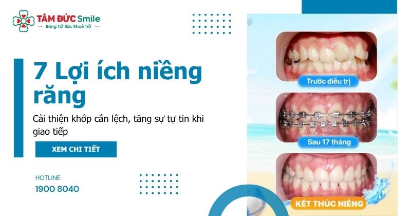 7 Lợi ích niềng răng tại Nha khoa Tâm Đức Smile – Đẹp và khỏe toàn diện