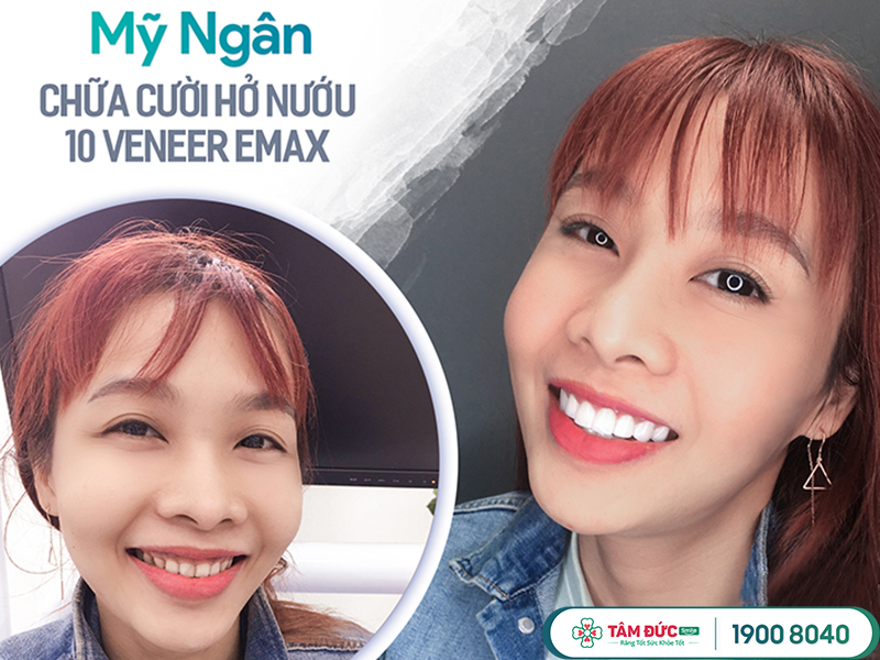 mặt dán sứ veneermax