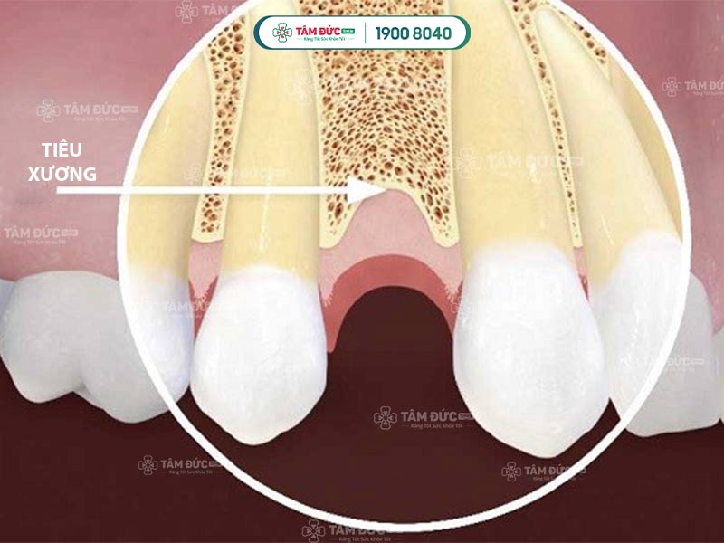 mất răng bao lâu thì bị tiêu xương hàm