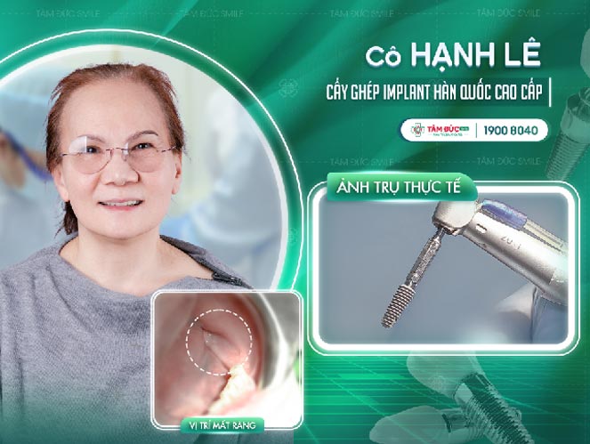 khách hàng điều trị mất răng số 7 hàm dưới 