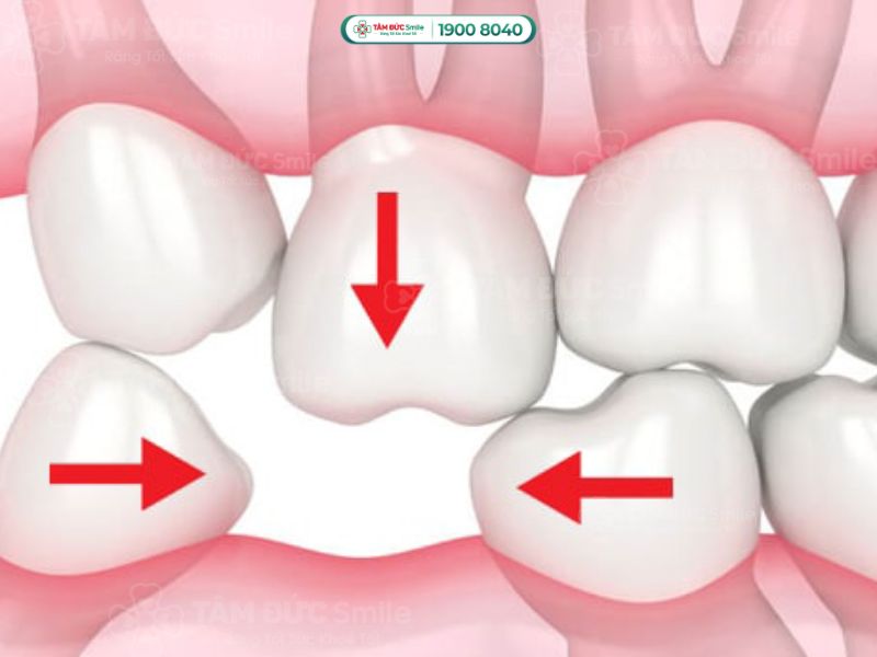 MẤT RĂNG LÂU NĂM CÓ TRỒNG RĂNG IMPLANT ĐƯỢC KHÔNG