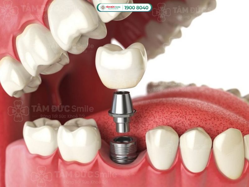 MẤT RĂNG LÂU NĂM CÓ TRỒNG RĂNG IMPLANT ĐƯỢC KHÔNG