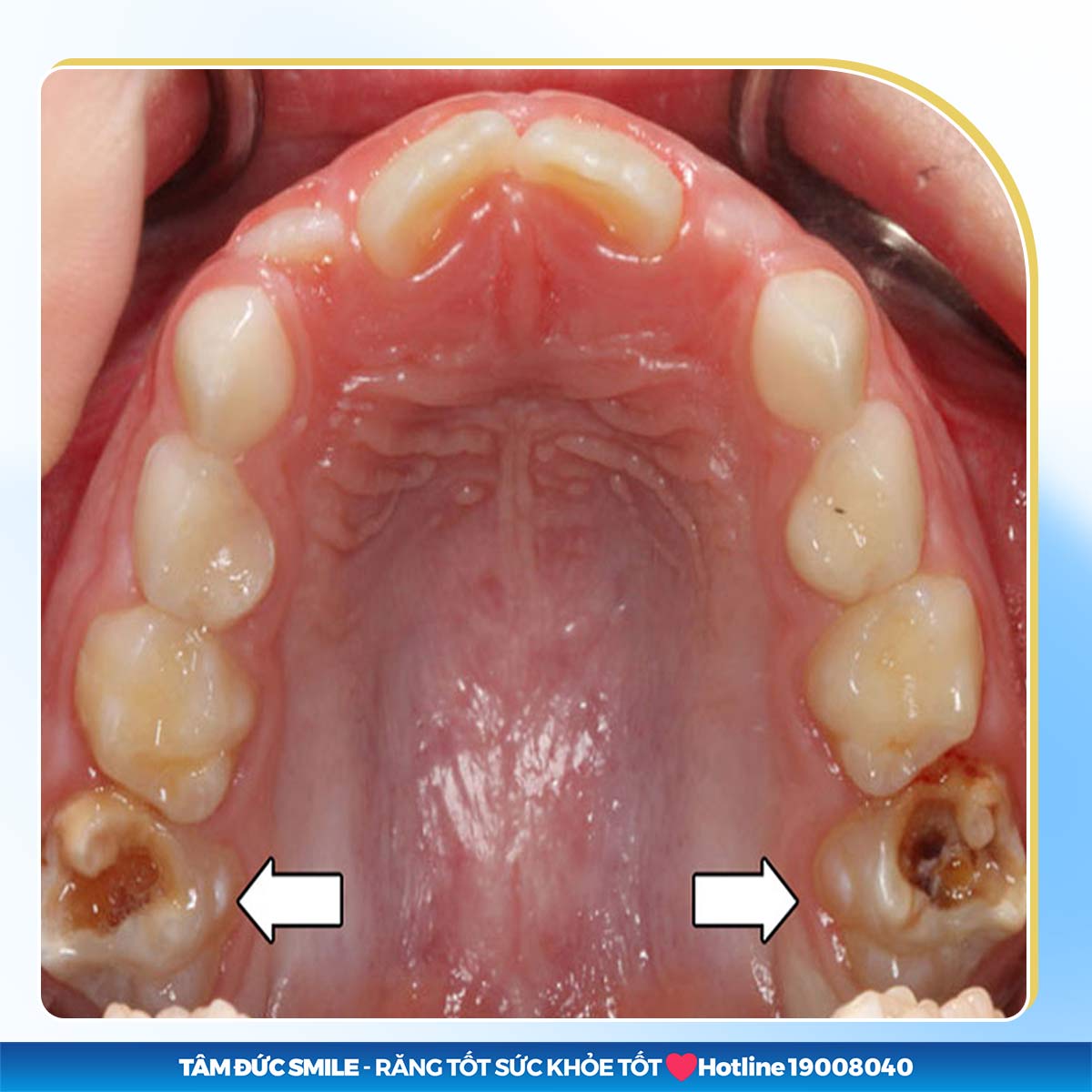 phục hình mất răng số 6