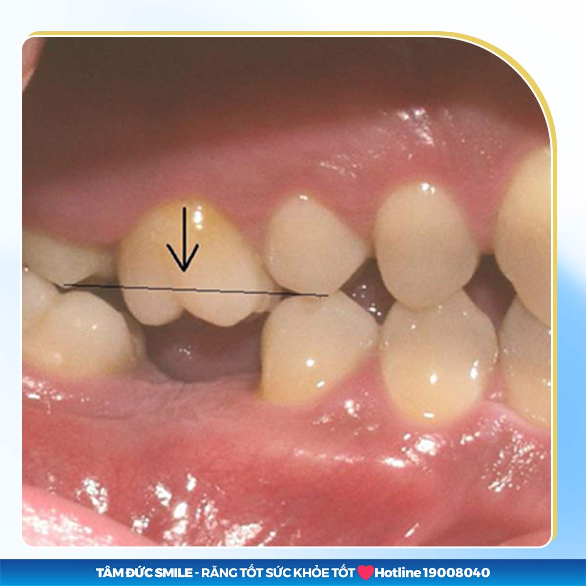 các răng kế cạnh bị xô lệch khi răng số 6 mất đi