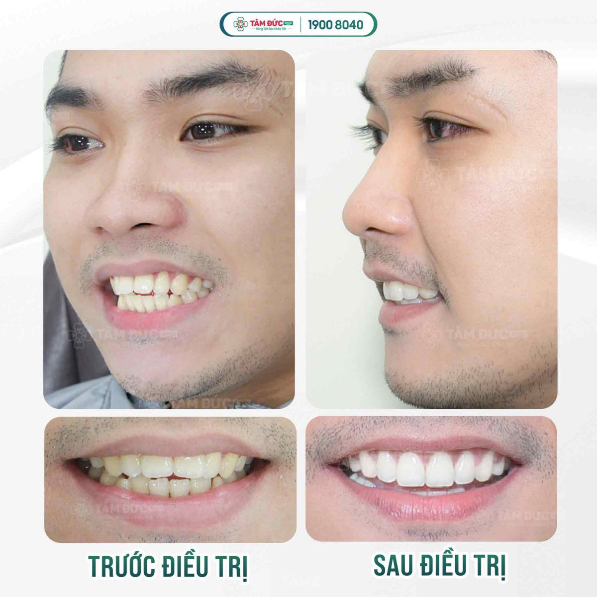 hình ảnh khách hàng trước và sau khi niềng răng tại nha khoa tâm đức smile