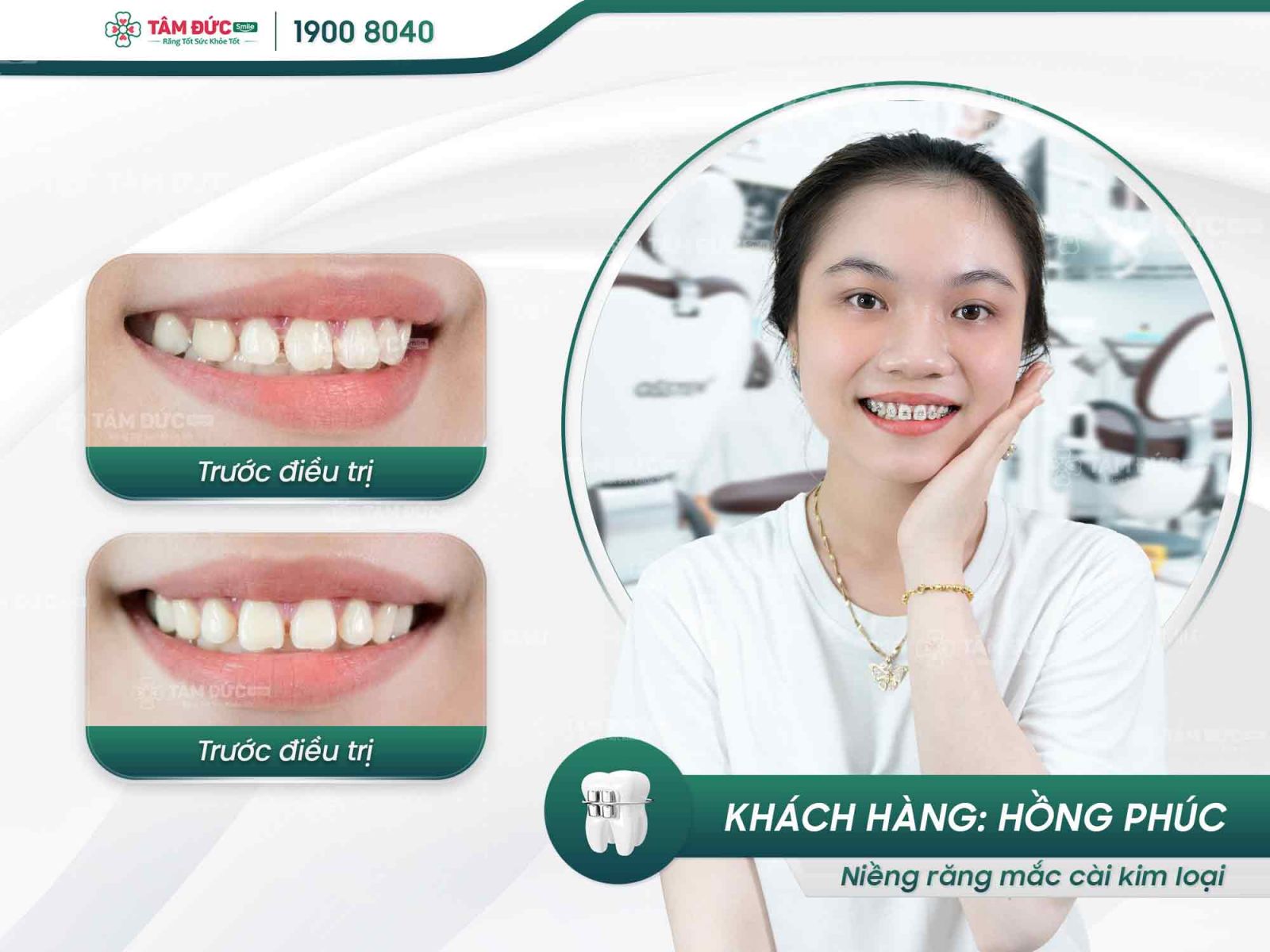 khách hàng niềng răng mắc cài kim loại tại nha khoa Tâm Đức Smile