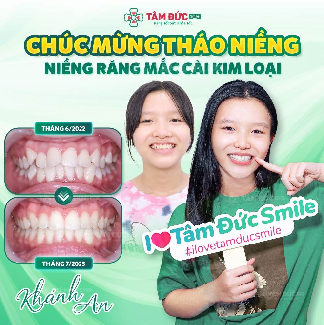 khách hàng kết thúc các giai đoạn niềng răng mắc cài tại tâm đức smile