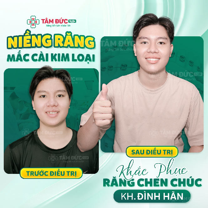 khách hàng kết thúc các giai đoạn niềng răng mắc cài tại tâm đức smile