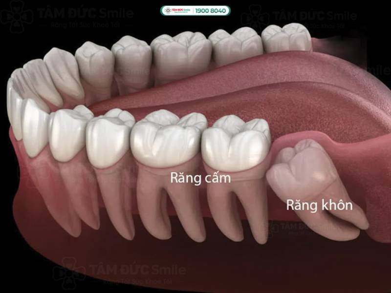 mọc răng cấm bị đau phải làm sao