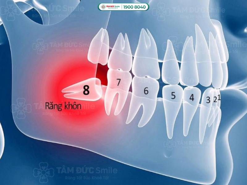 mọc răng cấm bị đau phải làm sao