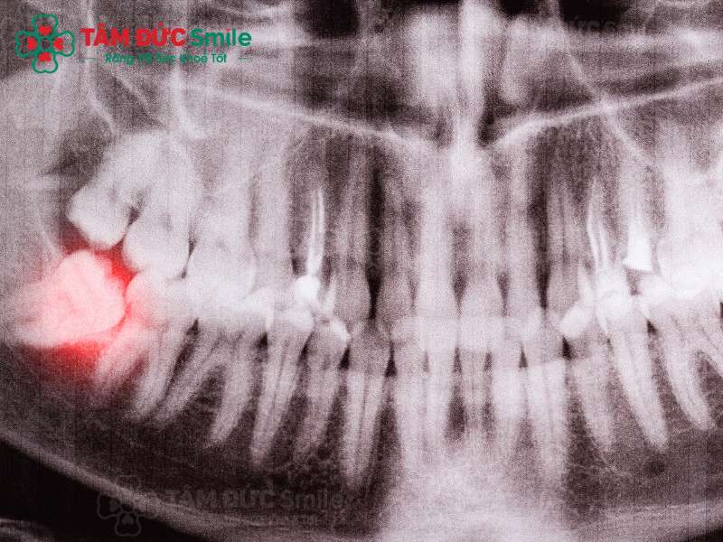 ảnh chụp mọc răng khôn bị sưng nướu