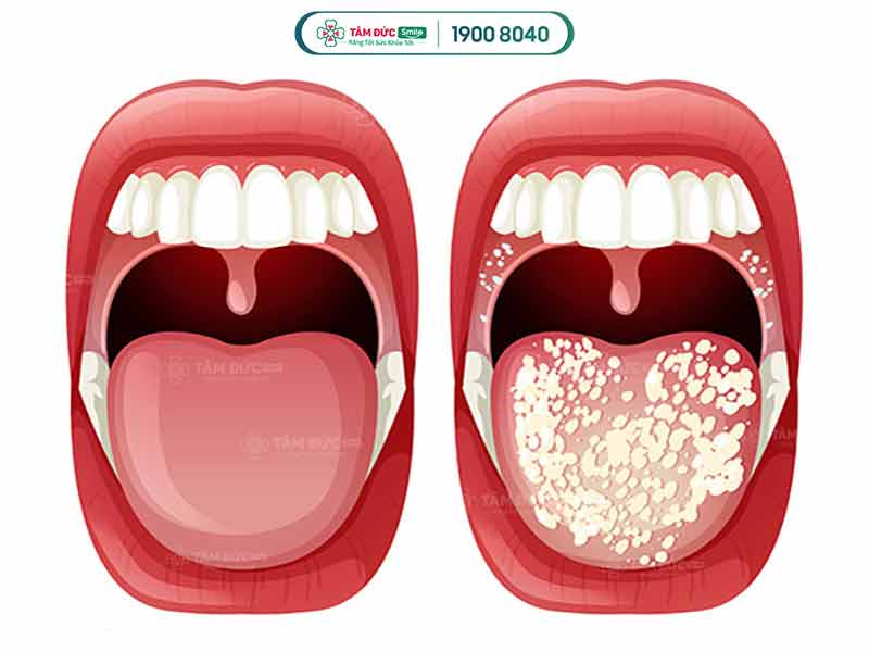 nấm miệng candida