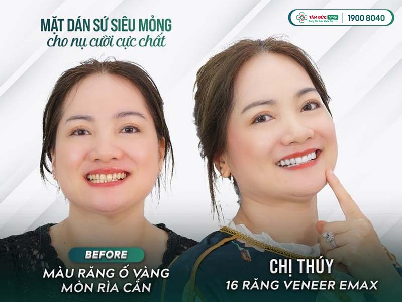 khách hàng dán sứ veneer tại nha khoa Tâm Đức Smile