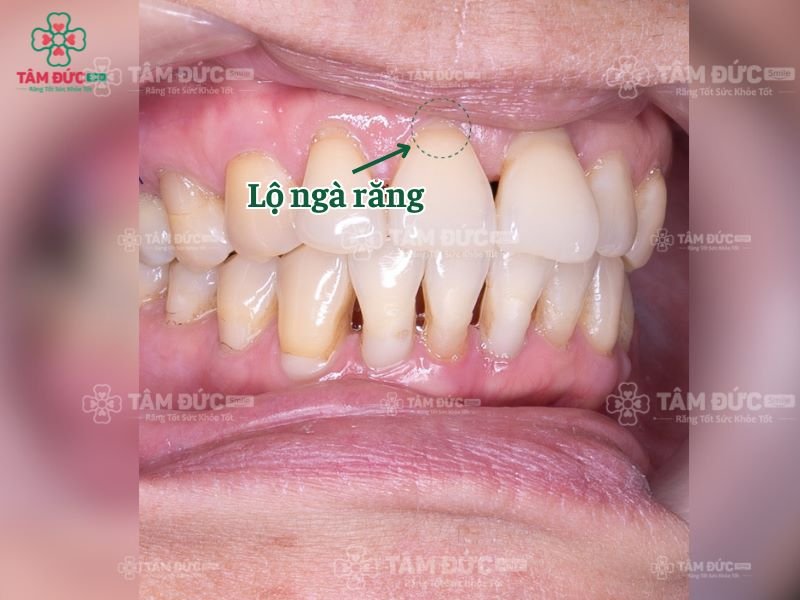 lộ ngà răng có thể làm mất răng vĩnh viễn