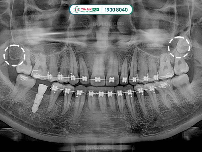 mọc răng khôn là nguyên nhân bị viêm nướu răng có mủ