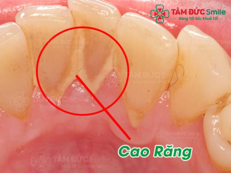 lấy cao răng định kỳ sẽ giúp giảm tình trạng nướu răng chảy máu