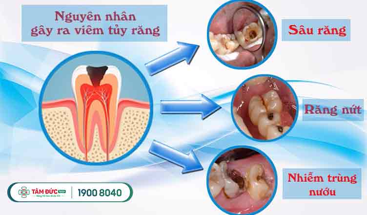 các nguyên nhân gây viêm tuỷ