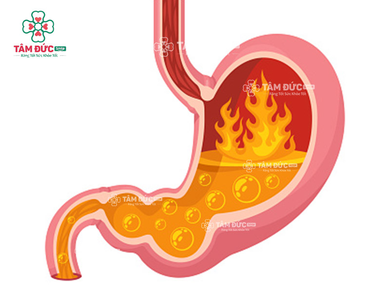 trào ngược dạ dày là nguyên nhân gây hôi miệng