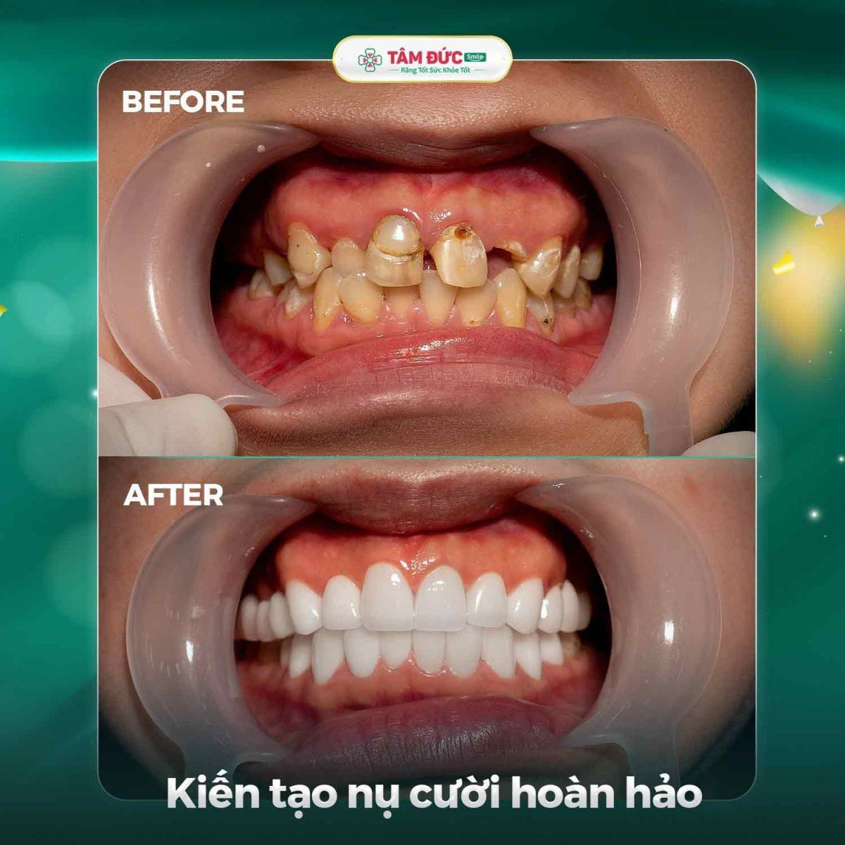 khách hàng trước và sau khi khắc phục răng sứ bị rơi ra tại nha khoa Tâm Đức Smile