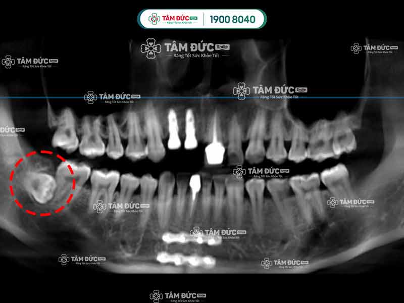 phim x-quang thể hiện răng mọc ngầm ở vị trí răng khôn