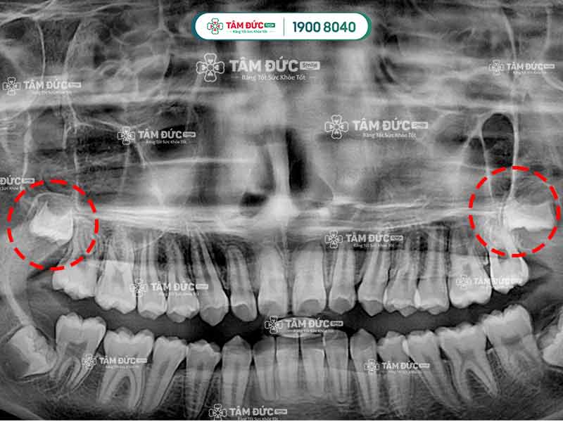 dấu hiệu răng mọc ngầm