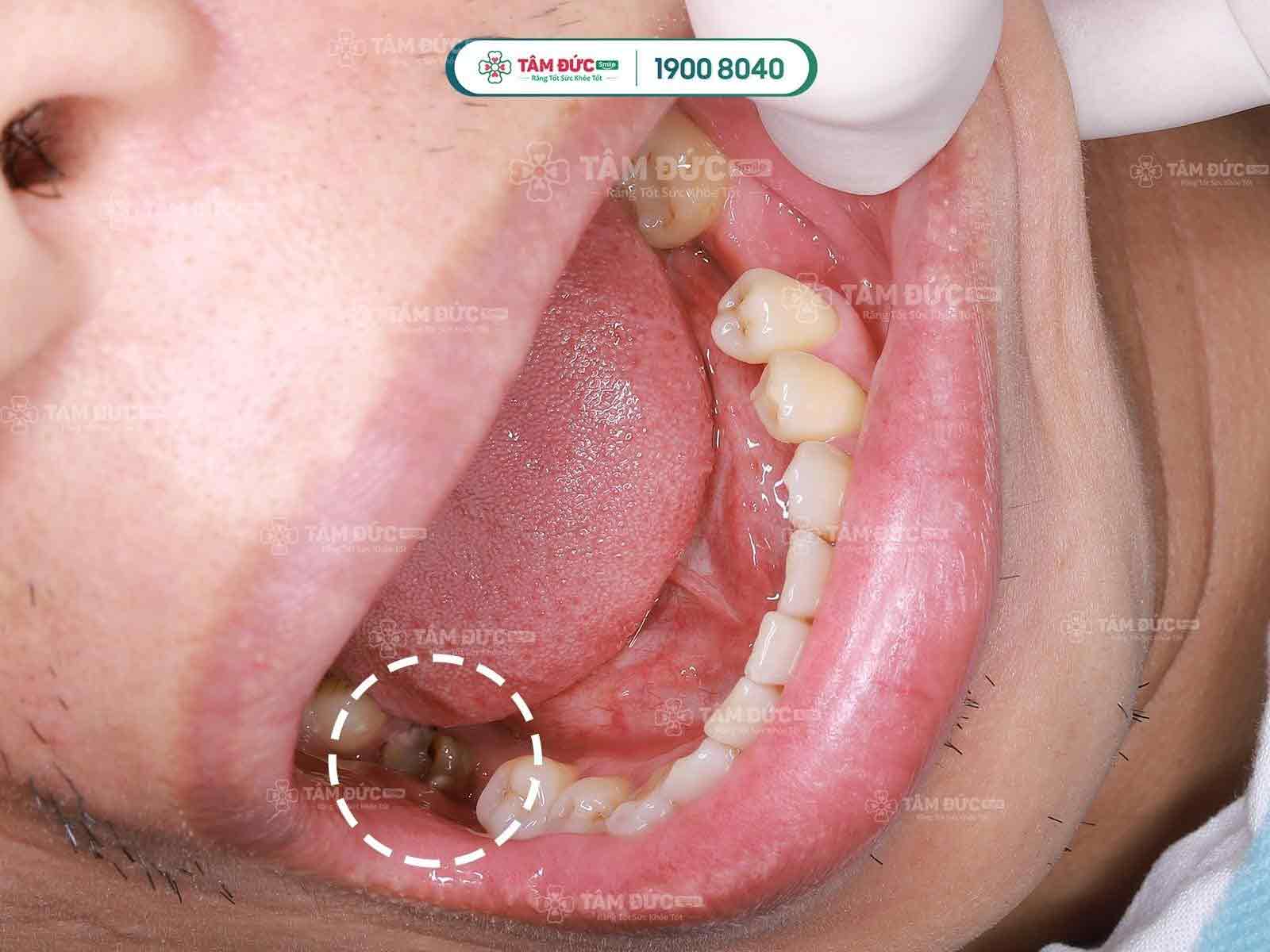 điều trị viêm tuỷ cấp tại nha khoa Tâm Đức Smile