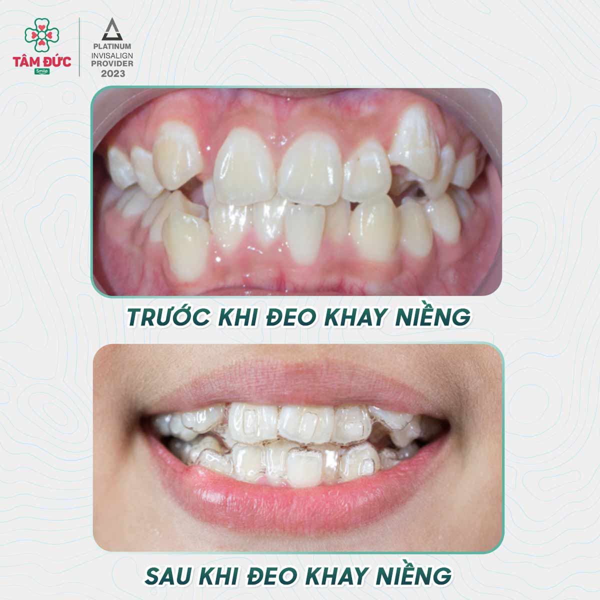 răng nanh mọc lệch khi niềng trong suốt