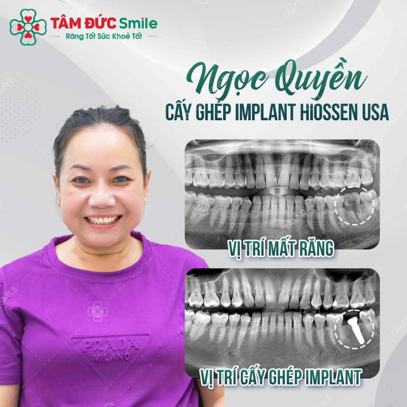 địa chỉ trồng răng implant uy tín tại bình thạnh