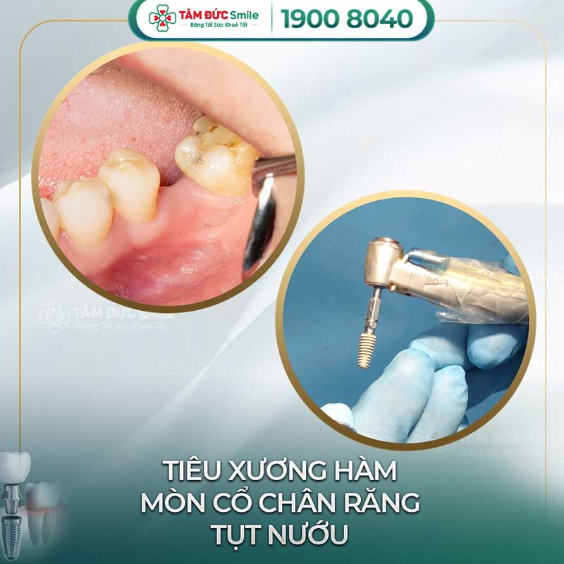 địa chỉ trồng răng implant uy tín tại bình thạnh