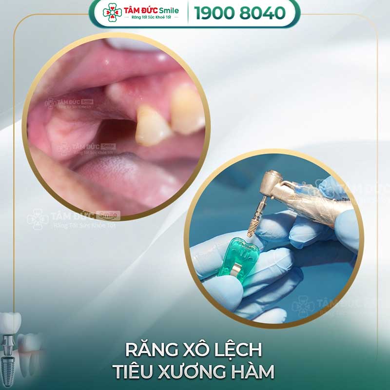 địa chỉ trồng răng implant uy tín tại bình thạnh