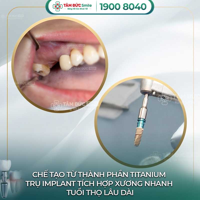 địa chỉ trồng răng implant uy tín tại bình thạnh