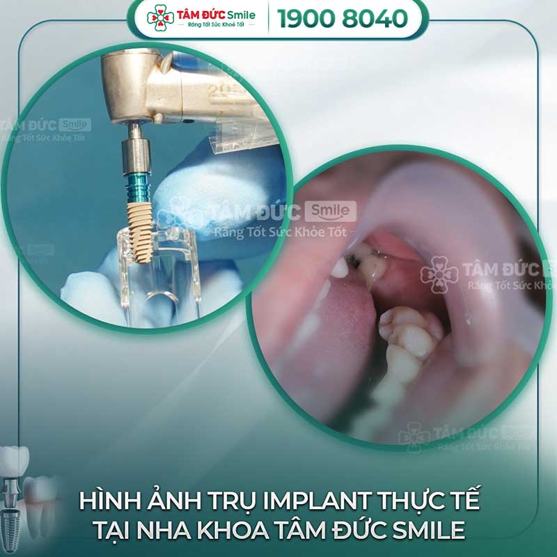 địa chỉ trồng răng implant uy tín tại bình thạnh