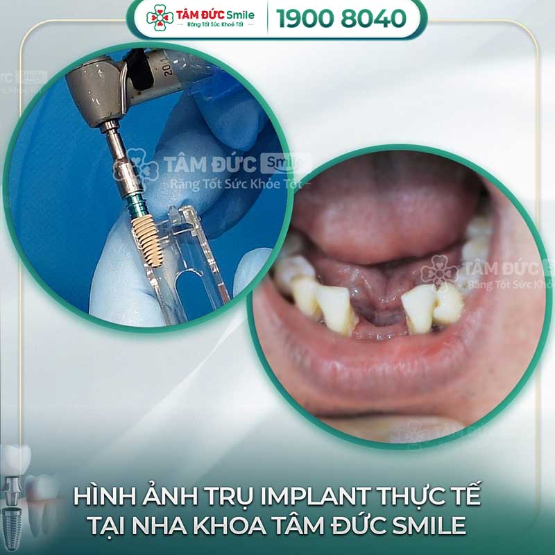 địa chỉ trồng răng implant uy tín tại bình thạnh