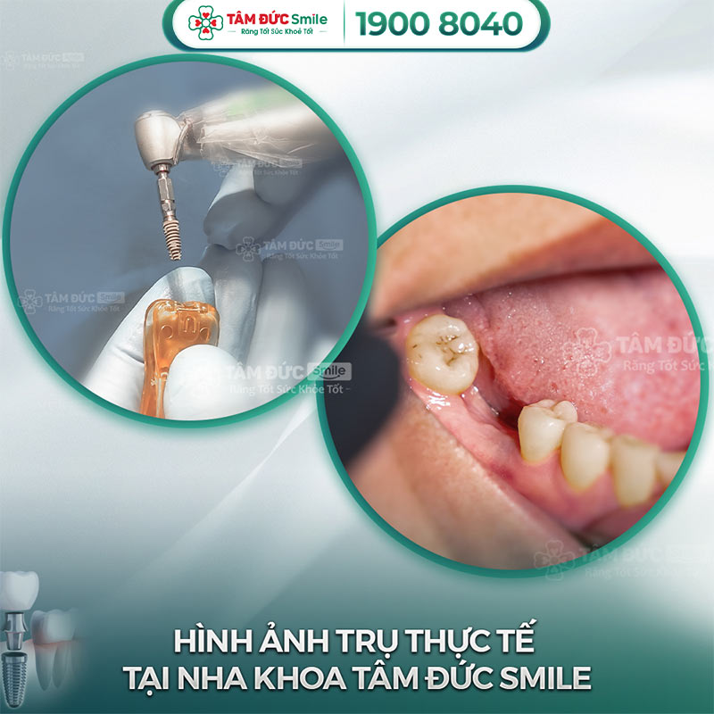 địa chỉ nha khoa trồng răng implant uy tín tại bình thạnh