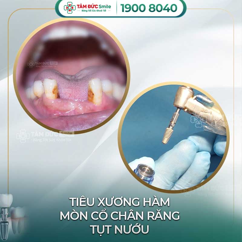 địa chỉ trồng răng implant uy tín tại bình thạnh